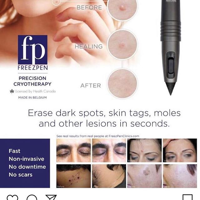 FreezPen (Precision Cryotherapy) treatment - Remove Dark Spots
